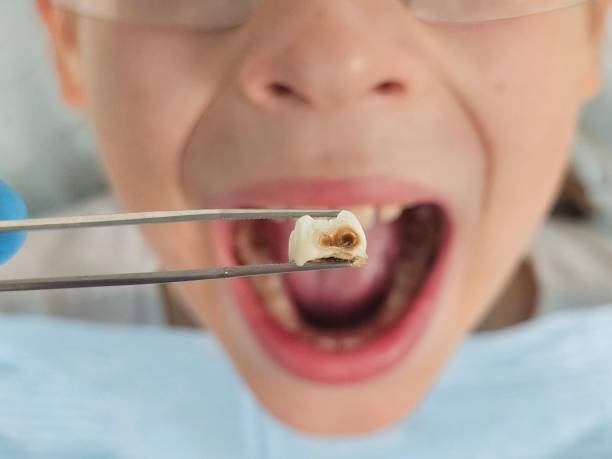 Best Emergency Wisdom Teeth Removal in Harlan, KY